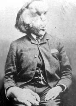 a black and white portrait of joseph merrick